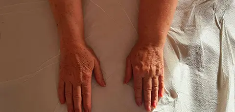 Linfedema secondario: come curarlo