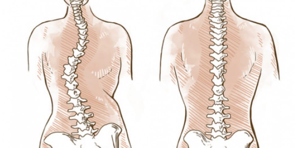 Curare la scoliosi con il Metodo Mézières